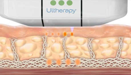 How does Ultherapy work
