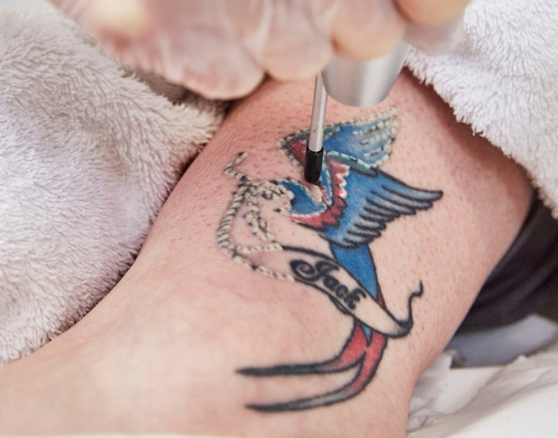 Lynton_Clinic_Tattoo Removal Close Up2-4799