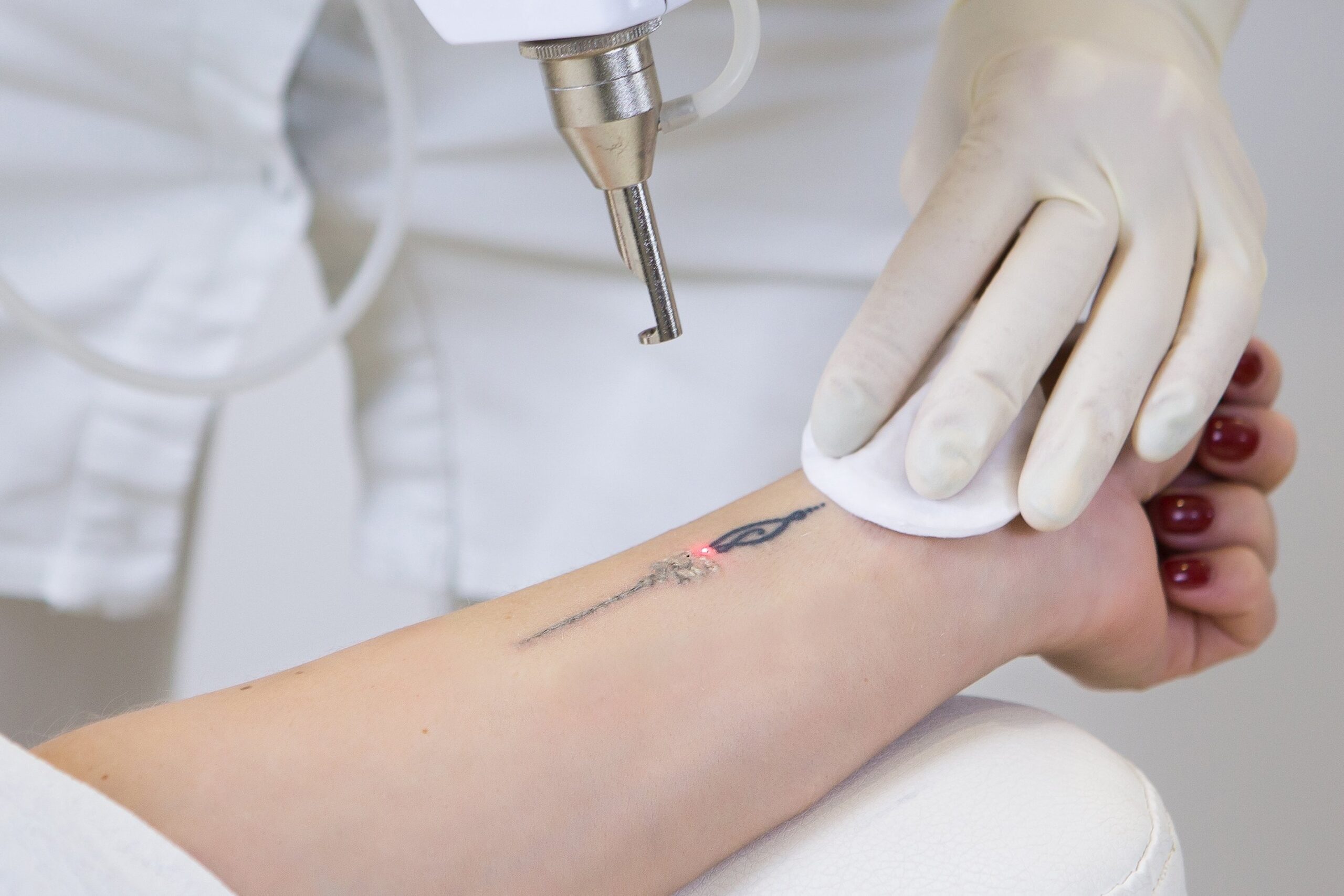 Best Tattoo Removal in Dubai - Laser Treatments