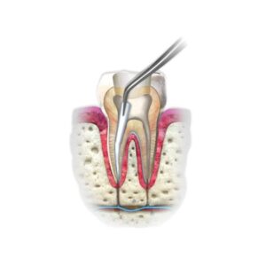 Cleaning the root canal