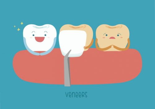Dental Veneer Aftercare​