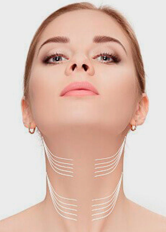 neck thread lift