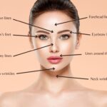 botox areas