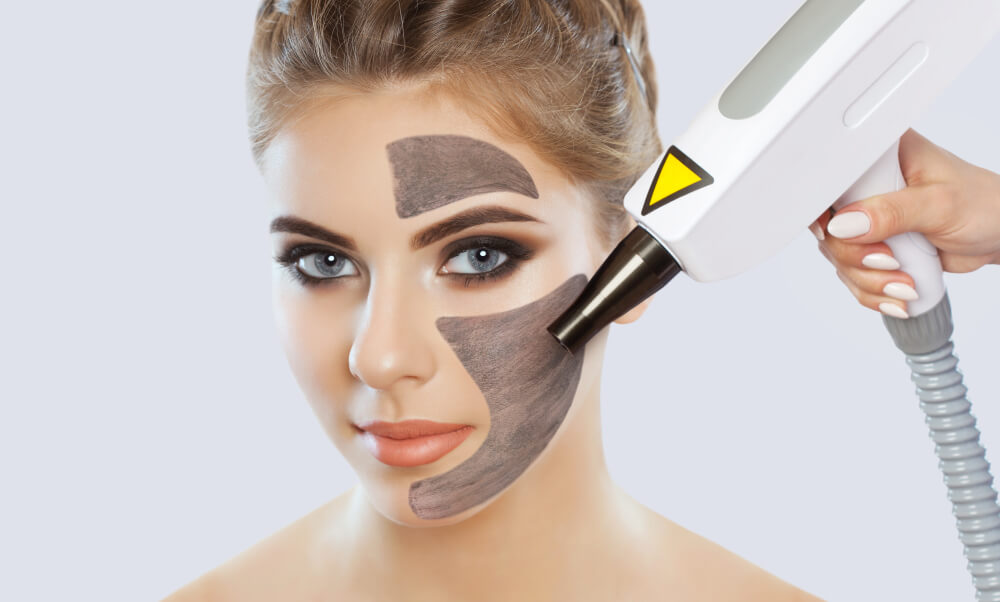 Carbon Peel Dubai ( carbon laser facial dubai 2023 )