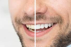 The cost of teeth whitening