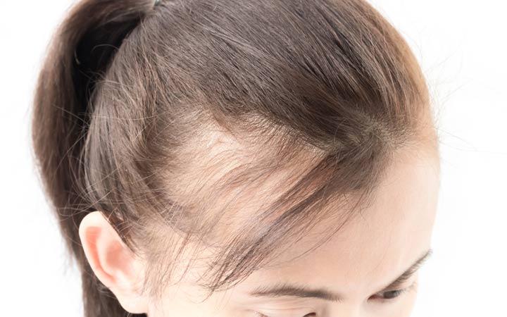 Types of alopecia
