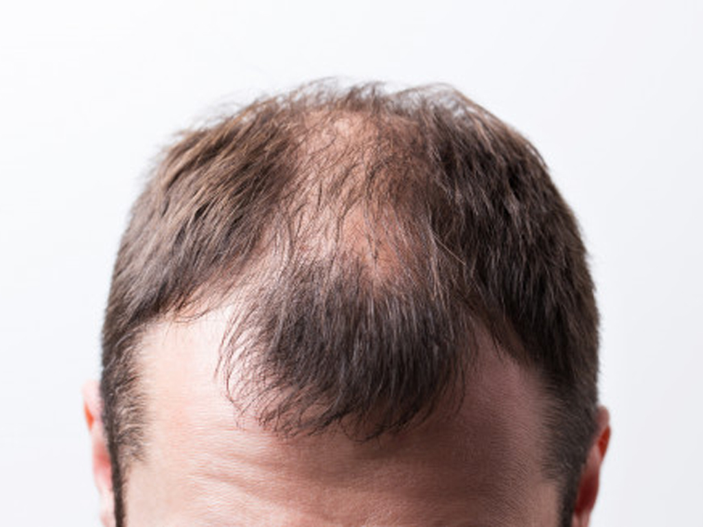 Familiarity with types of alopecia or baldness and its treatment