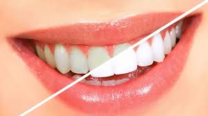 Getting to know the types of stains and discoloration of teeth