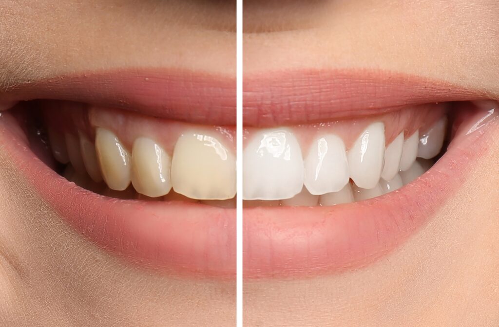 Advantages and disadvantages of teeth bleaching 2023