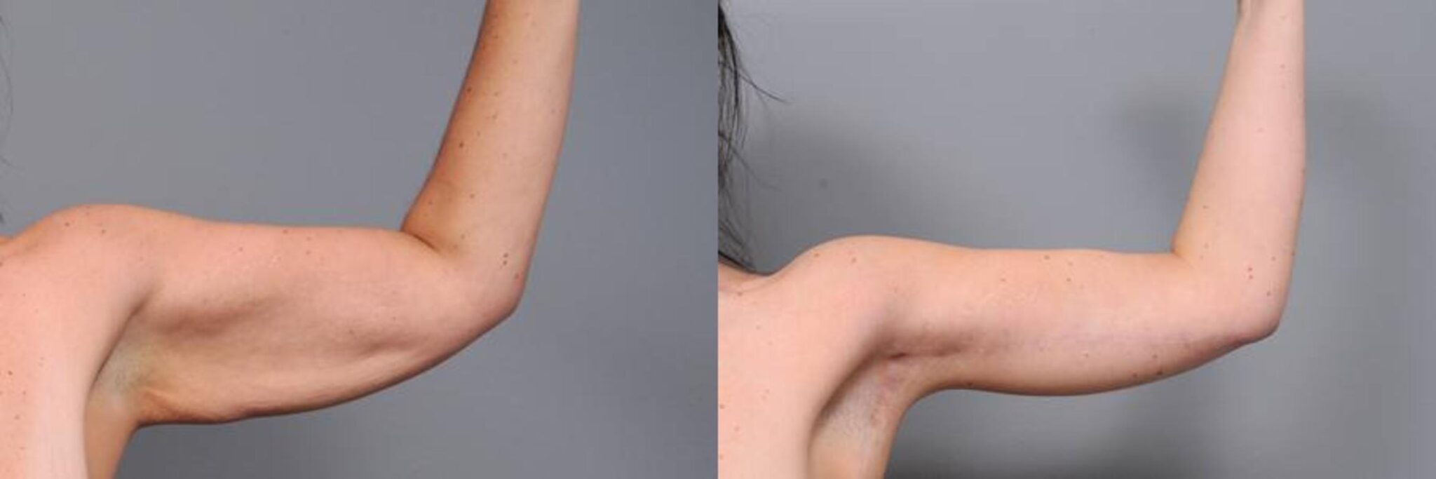 Types of arm lift methods 2023 (Dubai)