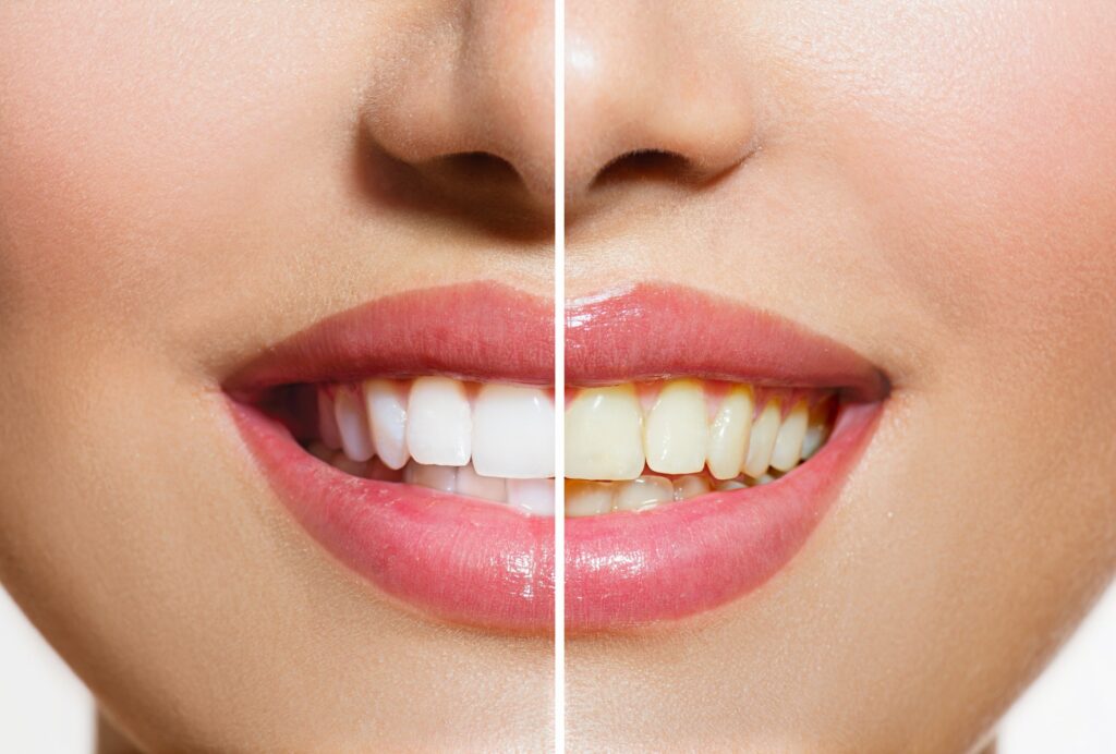 Teeth whitening with composite