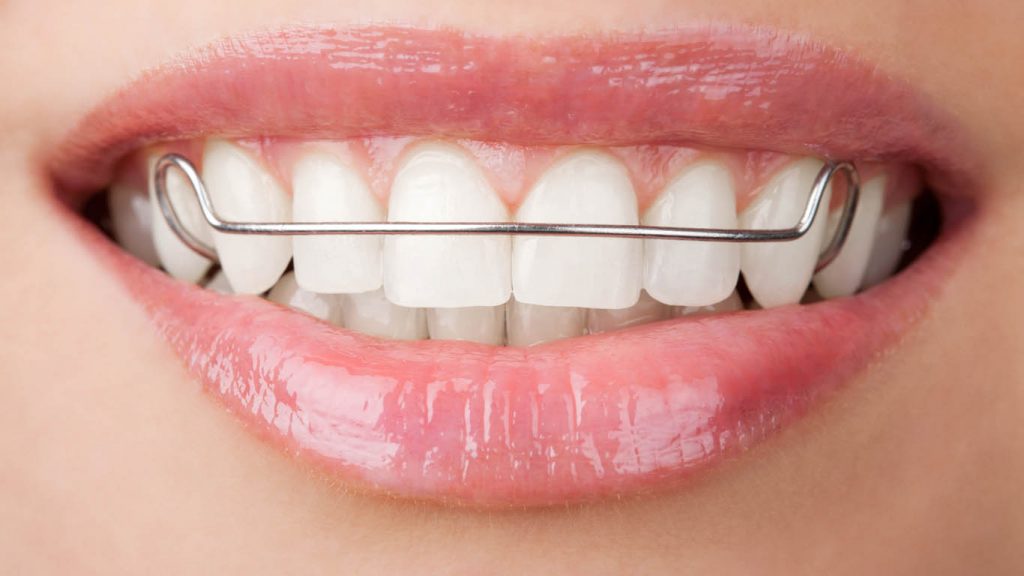 types of orthodontic treatments