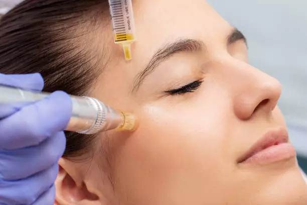 mesotherapy aftercare