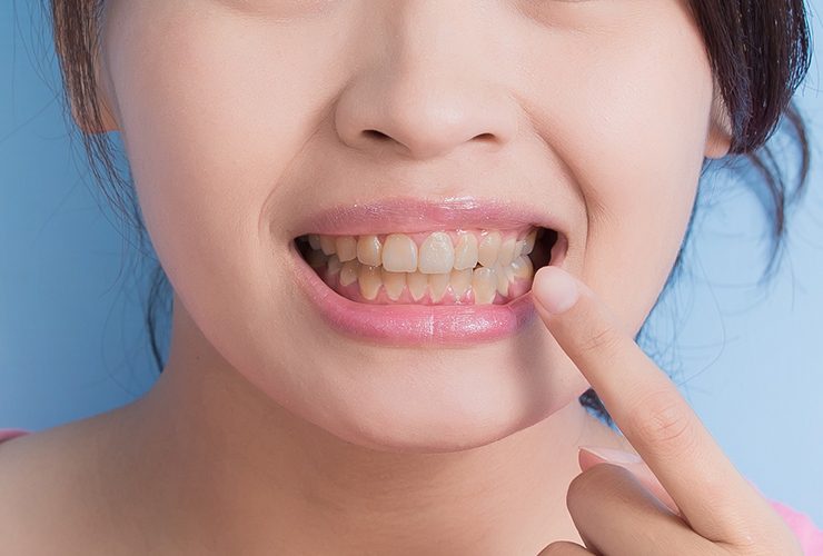 Home remedies for loose teeth