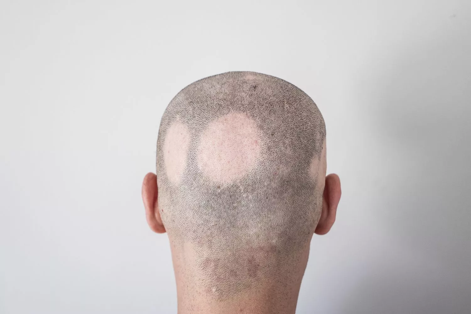 alopecia hair loss