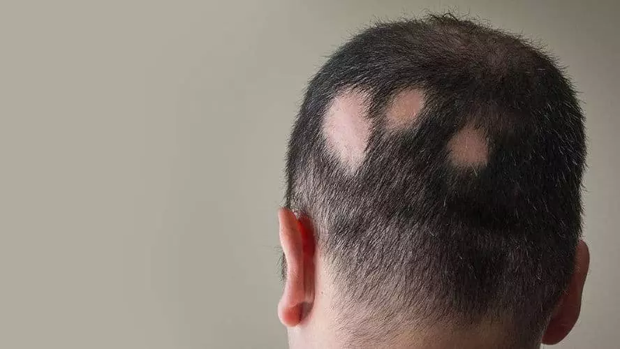 areata hair loss