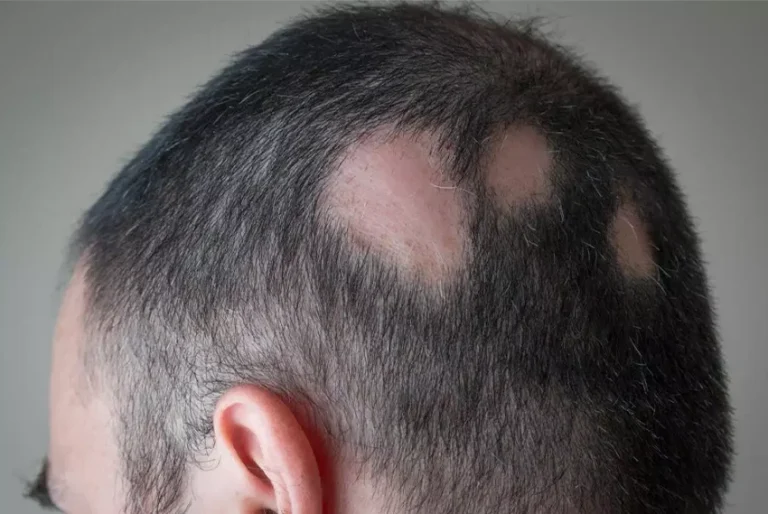 Alopecia areata