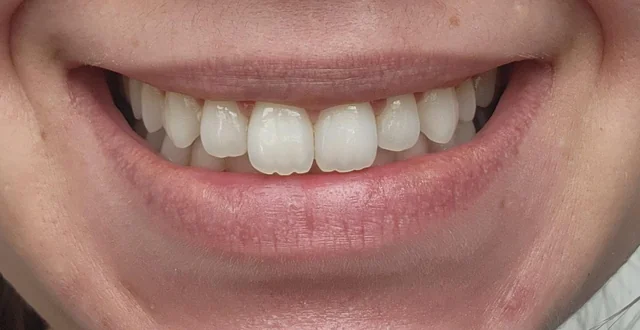 Causes of rabbit teeth