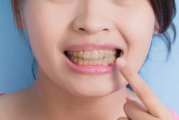 loose teeth: causes, Treatments 2 Home remedies for loose teeth