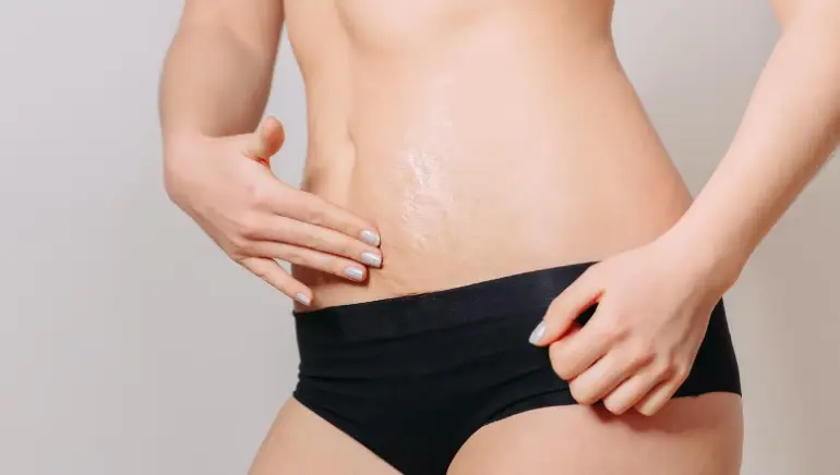 Home treatment for stretch marks
