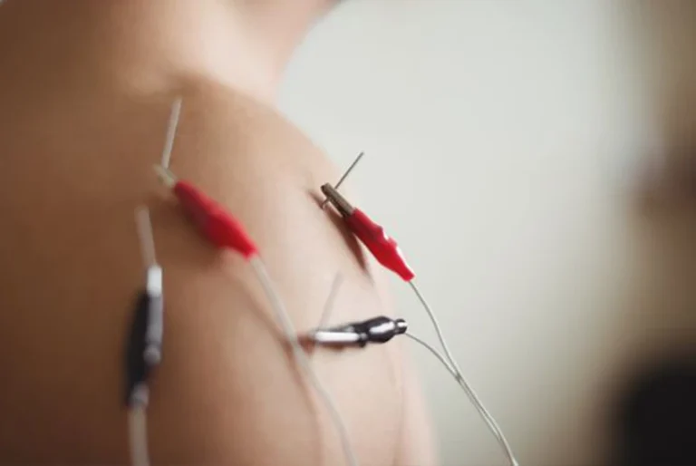 Rejuvenation with Electroneedling