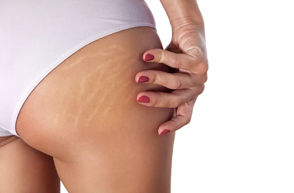 What is stretch marks