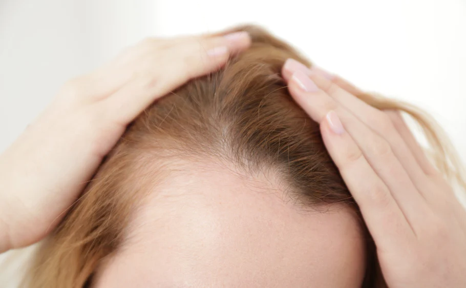 traction hair loss (traction alopecia) 1 traction alopecia