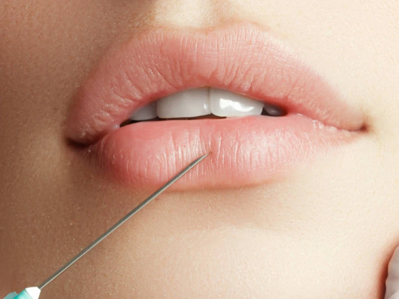 Types of Fillers 1 lip filler dubai
