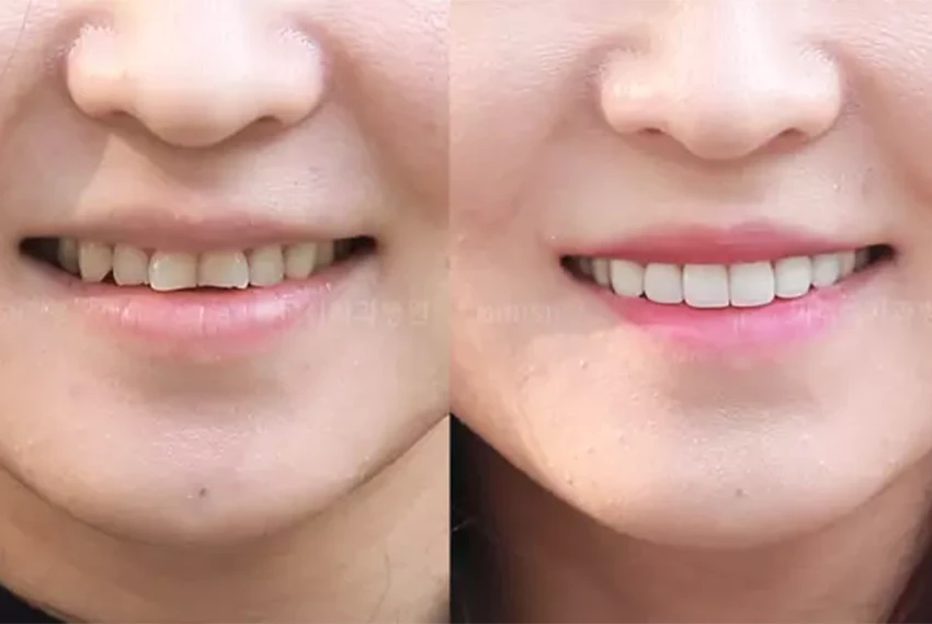 rabbit tooth composite