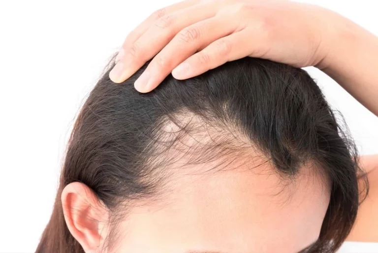 traction alopecia