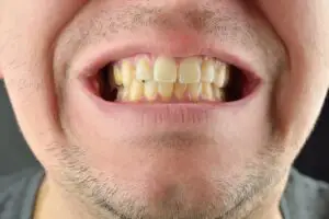cause of yellow teeth