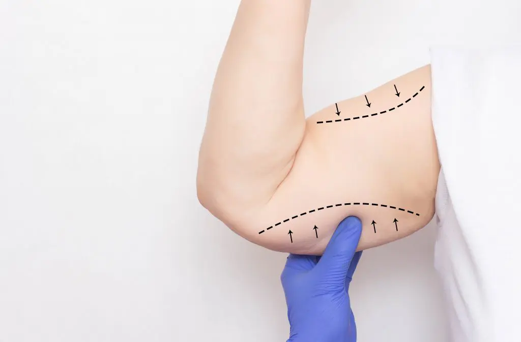 Arm lift methods