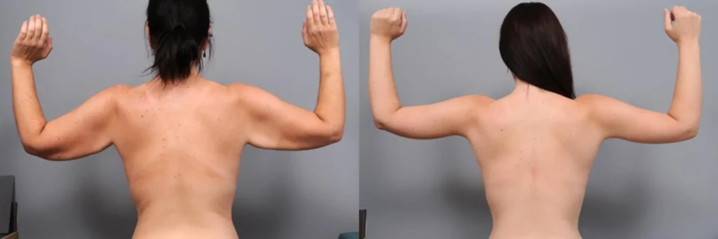 Benefits of arm lift surgery