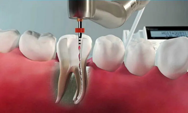 Root Canal Treatment Dubai 3 Can root canals fail