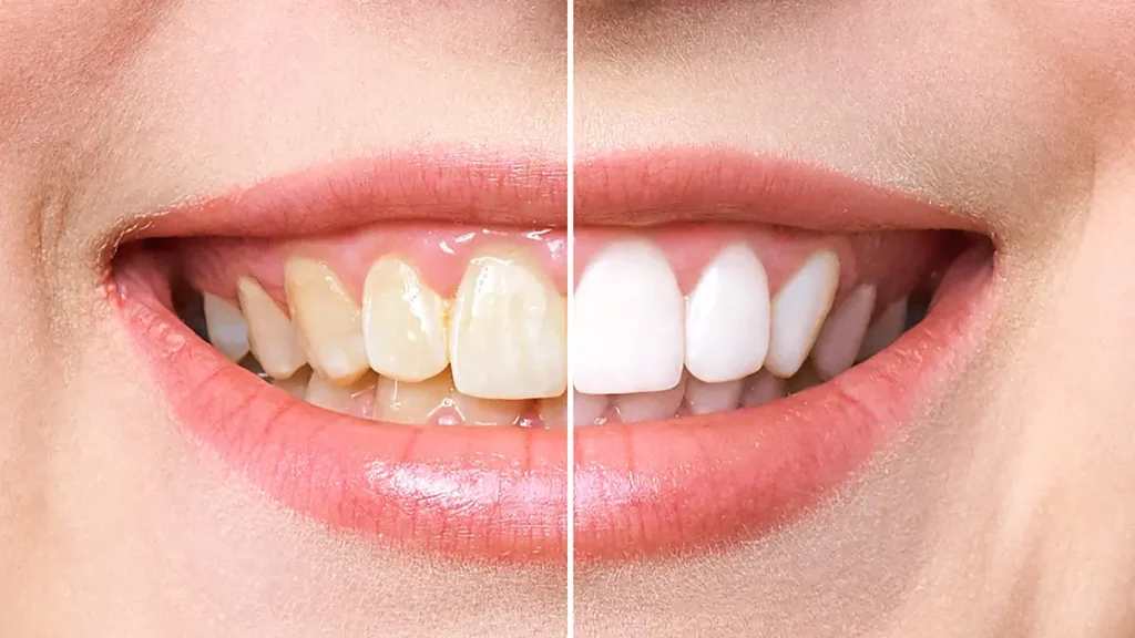 Cons of professional teeth whitening