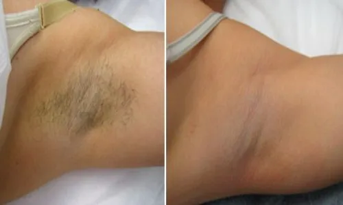 Darkening of the skin after the laser