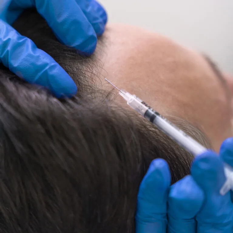 Hair Mesotherapy