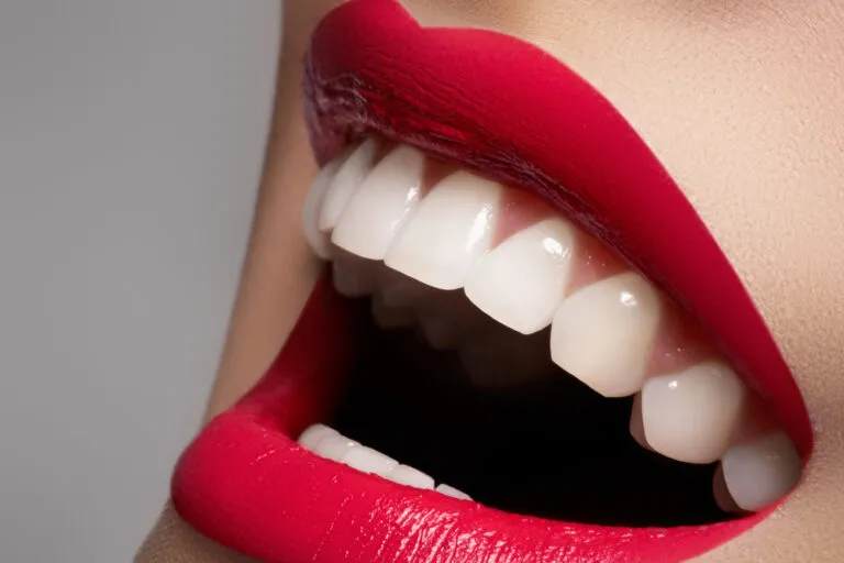 Hollywood Smile Dubai 3 Hollywood-smile-Dubai-price