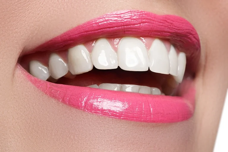 Hollywood Smile Dubai 7 Hollywood-smile-veneers