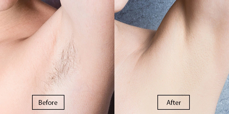 How to prevent darkening and burns after laser