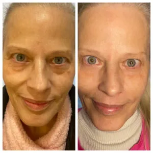 lumecca Treatment (IPL Treatment) 4 IPL-Treatment-Marina
