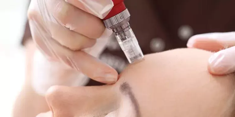 Is-RF-microneedling-painful
