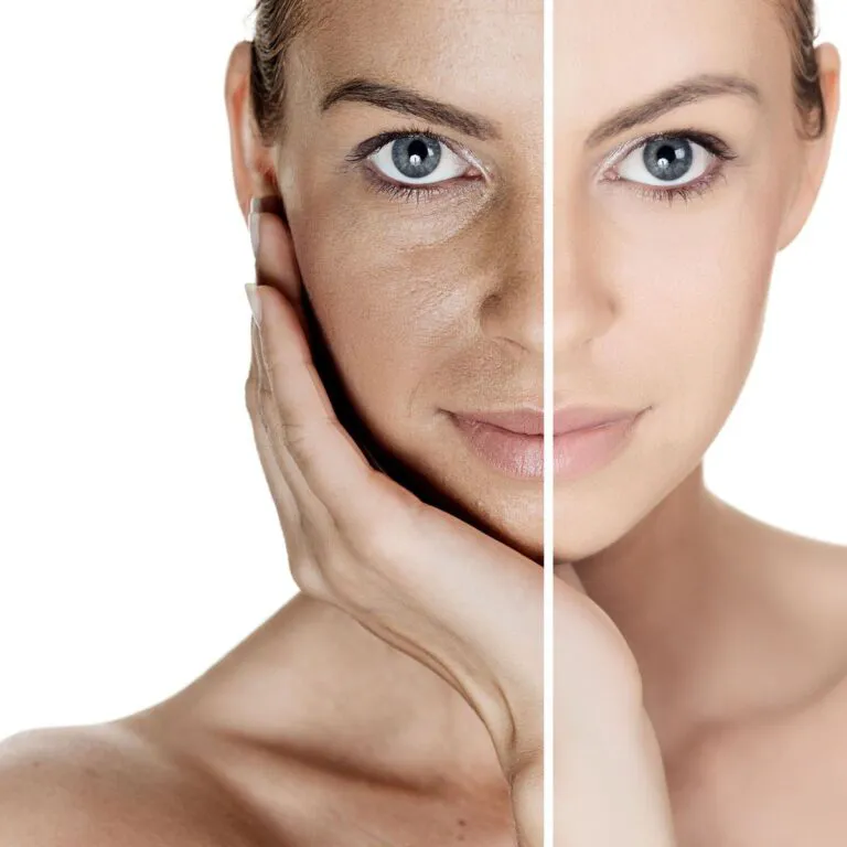 Tratamiento-Laser-Q-Switch-Micropigmentacion-de-piel