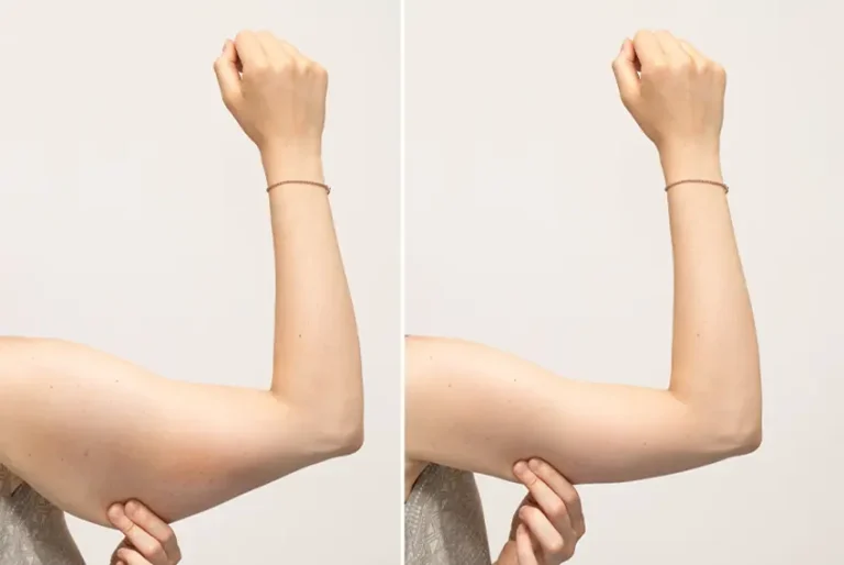 Arm lift
