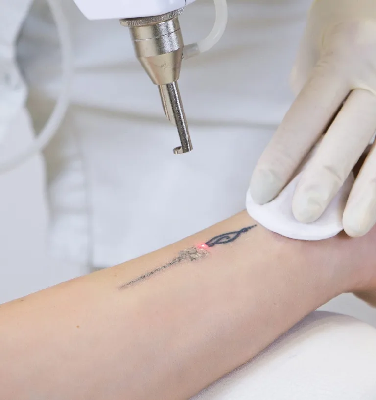 laser tattoo removal dubai