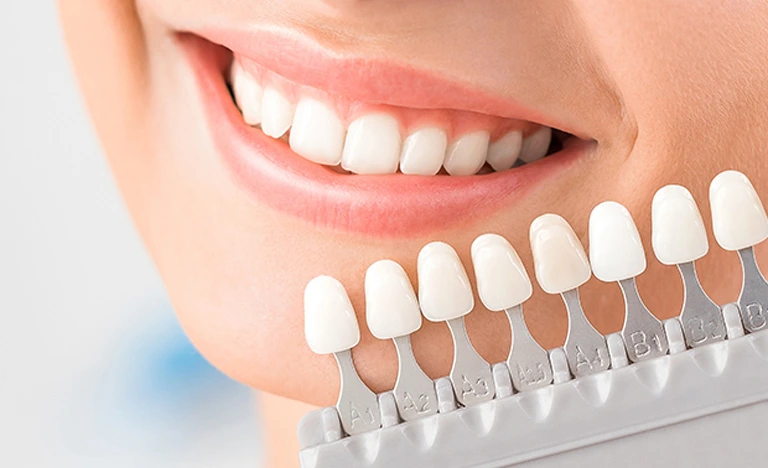 Veneers 10 veneers Dubai