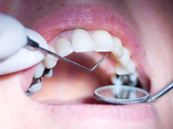 Composite Filling Dubai 9 composite filling dubai