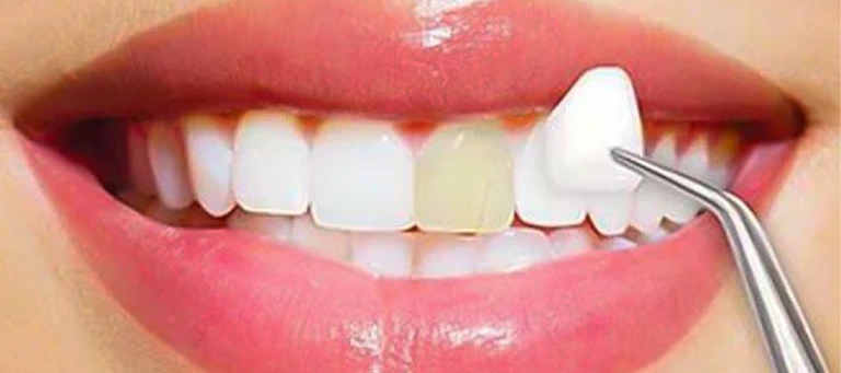 Veneers 11 veneers Dubai