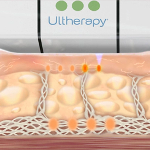 Ultherapy Treatment Dubai 2 ultherapy dubai marina