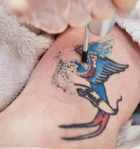 Laser tattoo removal with Lynton device at Serenity Dubai